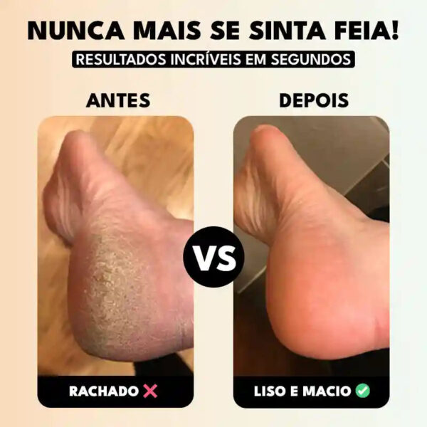 Lixa de Pé Elétrica Portátil Removedor de Calos e Rachaduras CallusCare - Imagem 3