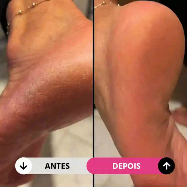 Lixa de Pé Elétrica Portátil Removedor de Calos e Rachaduras CallusCare - Imagem 4