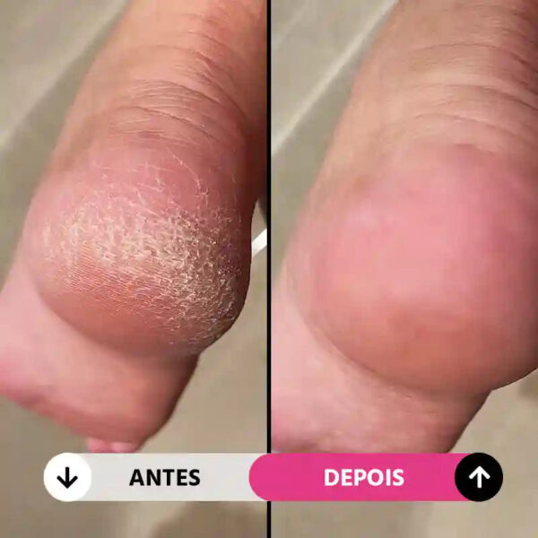 Lixa de Pé Elétrica Portátil Removedor de Calos e Rachaduras CallusCare - Imagem 5